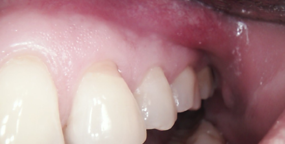 Close-up of a person's upper teeth and gums. Light pink gums with white teeth, and some reflection.
