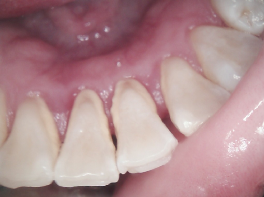 Close-up view of teeth and gums in a mouth. Teeth appear slightly yellowed, with pink gums.
