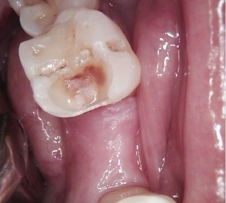 Close-up of a decayed molar with a brown cavity inside the mouth