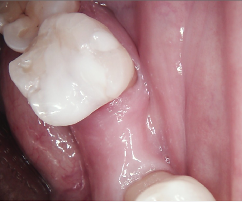 Close-up of a molar with pink gum tissue inside the mouth