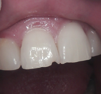 Close-up of two front teeth with a small chip at the edge of one tooth.