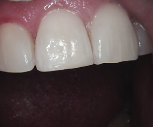 Close-up of three front teeth and pink gums with a dark mouth opening background