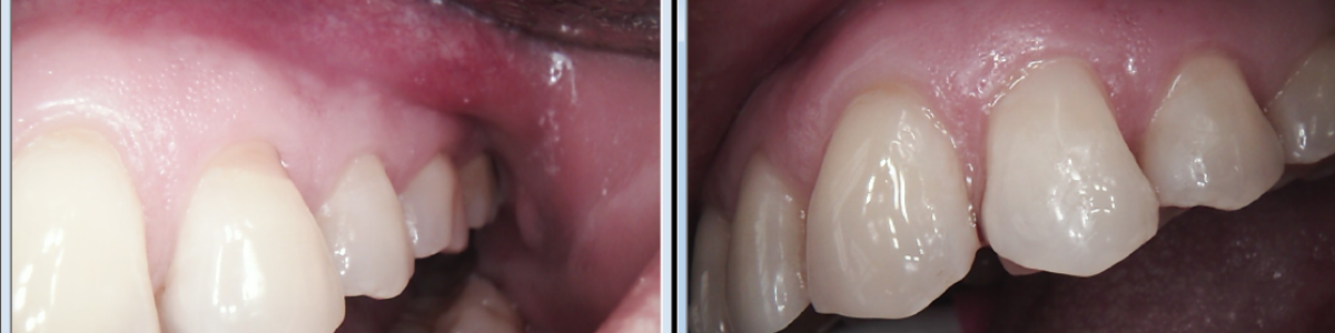 Two close-up views of teeth, gums, and inner cheek surfaces.