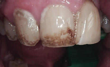 Close-up of front teeth with brown staining and white enamel, showing gums above.