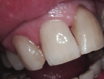 Close-up of front teeth with a chipped or misaligned tooth and pink gums visible