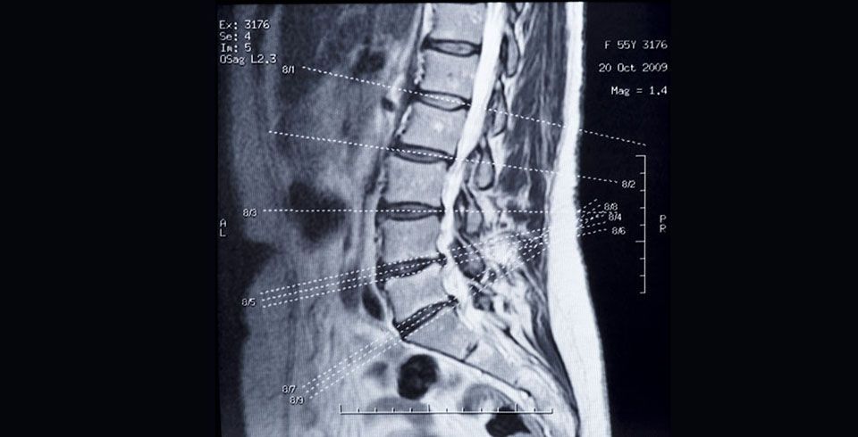 Xray image of spinal column