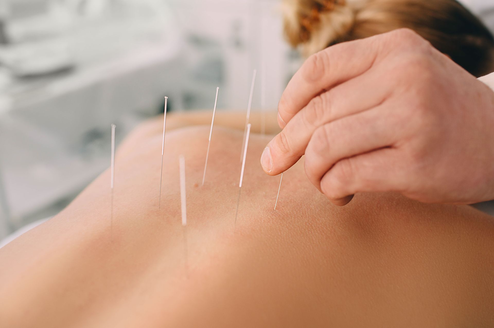 local acupuncture