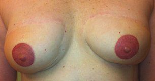 Areola restoration - after