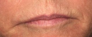 Before - full lip color