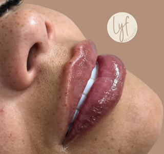 Close-up of a person's glossy, swollen lips, with white teeth visible, and the Lyf Aesthetics logo.