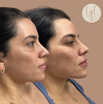 Side-by-side comparison of a person's profile before and after a cosmetic procedure, showing a more defined nose and filled cheek.