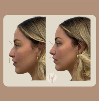 Side-by-side view of a woman's profile, before and after a nose procedure. Beige background, showing a refined nose shape.