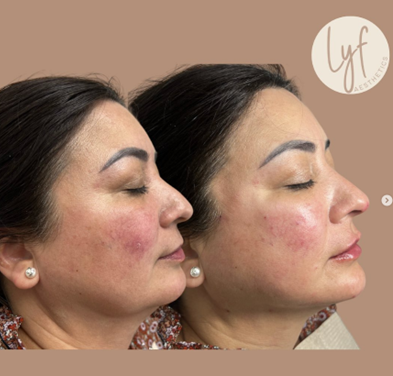 Before and after photos showing a person's face; facial redness reduced post-procedure.