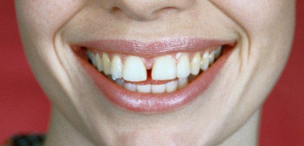 Gap in teeth