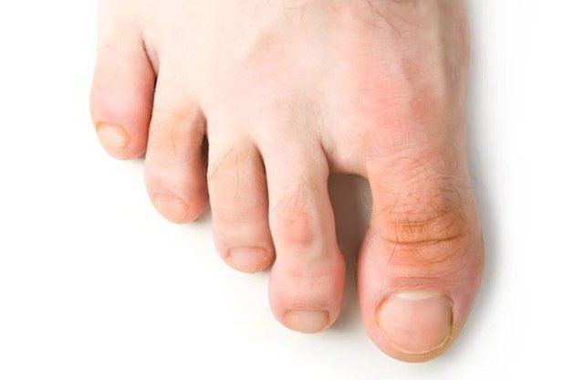 Treatment of all foot disorders