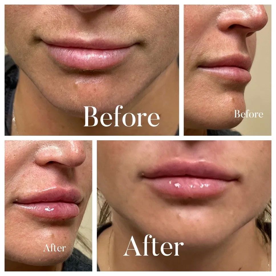 A collage of before and after photos of a woman 's lips.