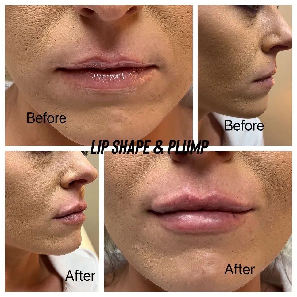 A collage of before and after photos of a woman 's lips.