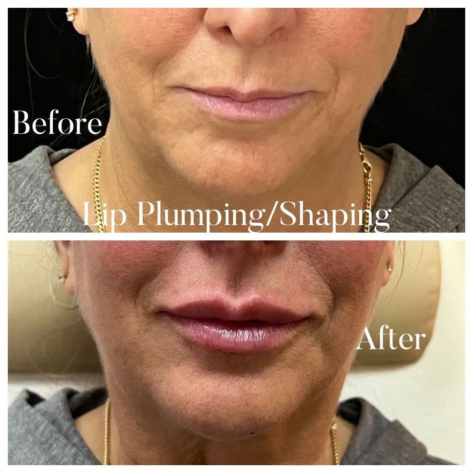 A before and after photo of a woman 's lip plumping / shaping treatment.