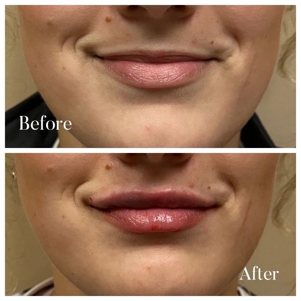 A before and after photo of a woman 's lips.