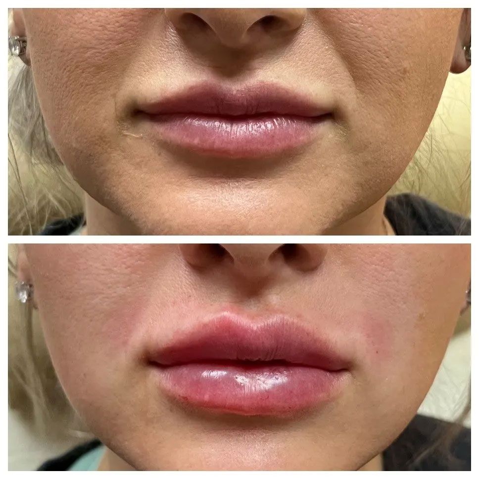 A before and after photo of a woman 's lips.