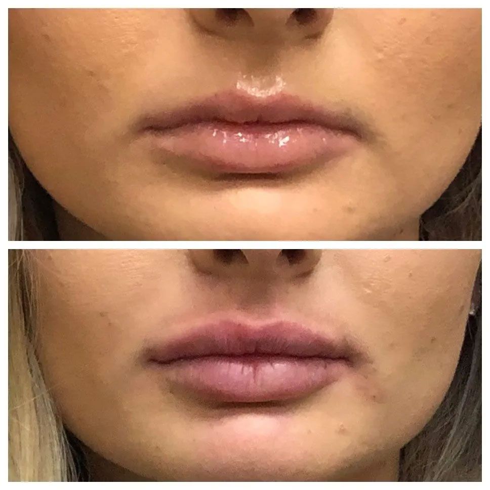 A before and after photo of a woman 's lips.