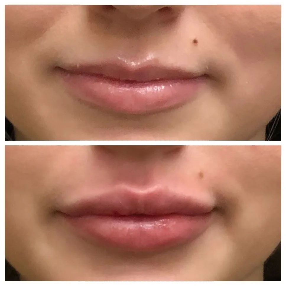 A before and after photo of a woman 's lips.