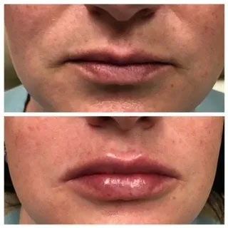 A before and after photo of a woman 's lips.