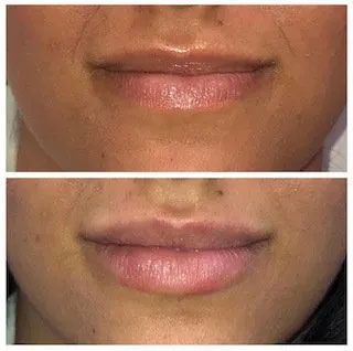 A before and after photo of a woman 's lips.