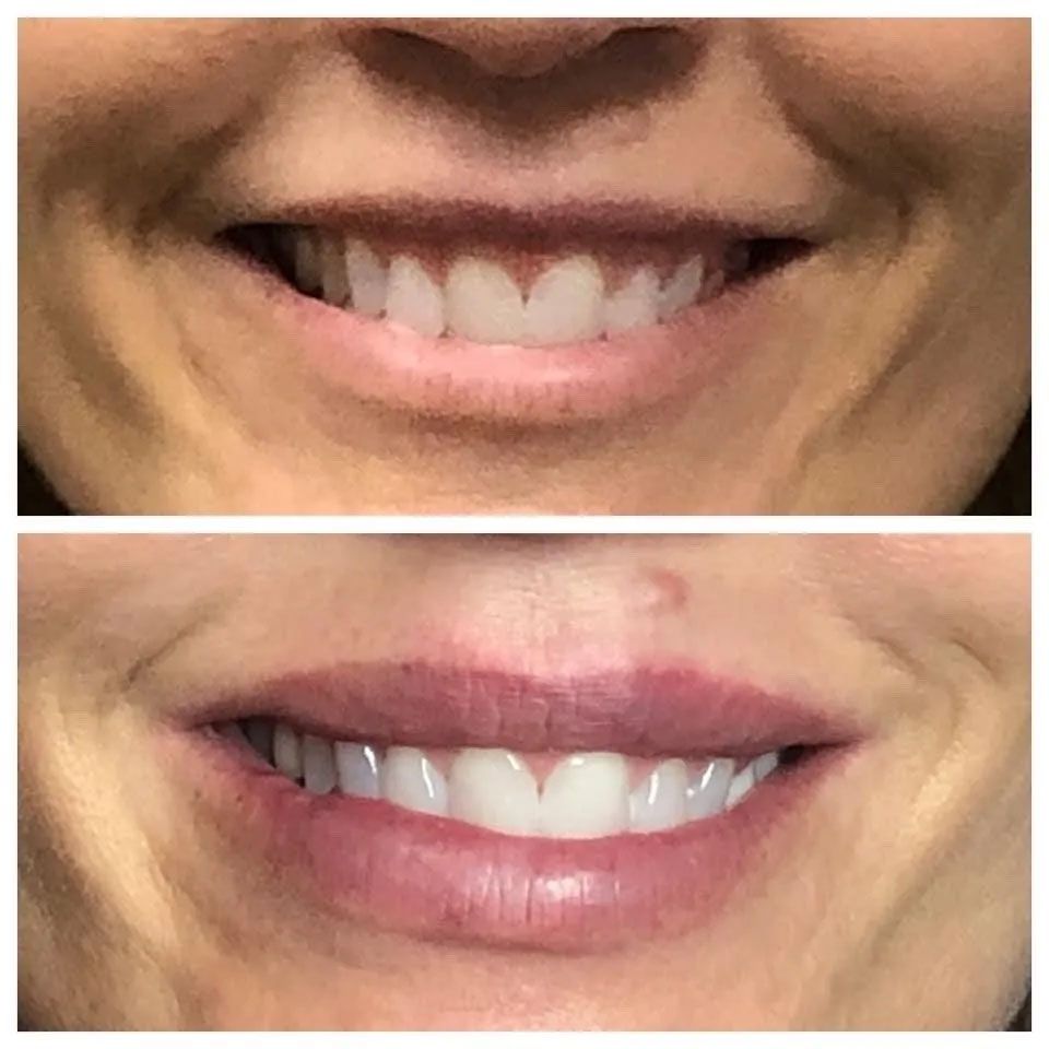 A before and after photo of a woman 's smile.