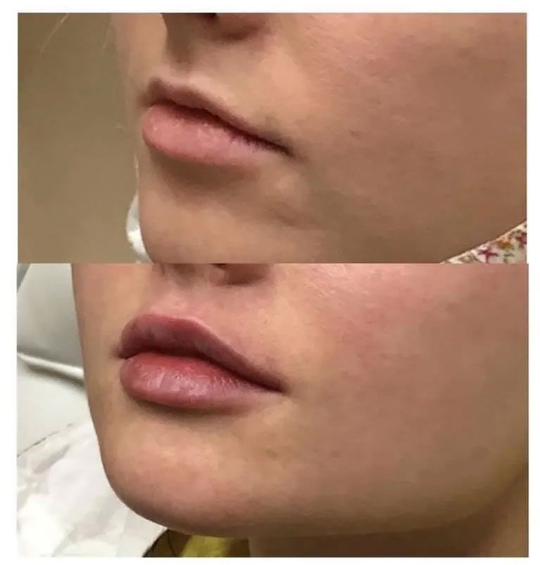 A before and after photo of a woman 's lips.