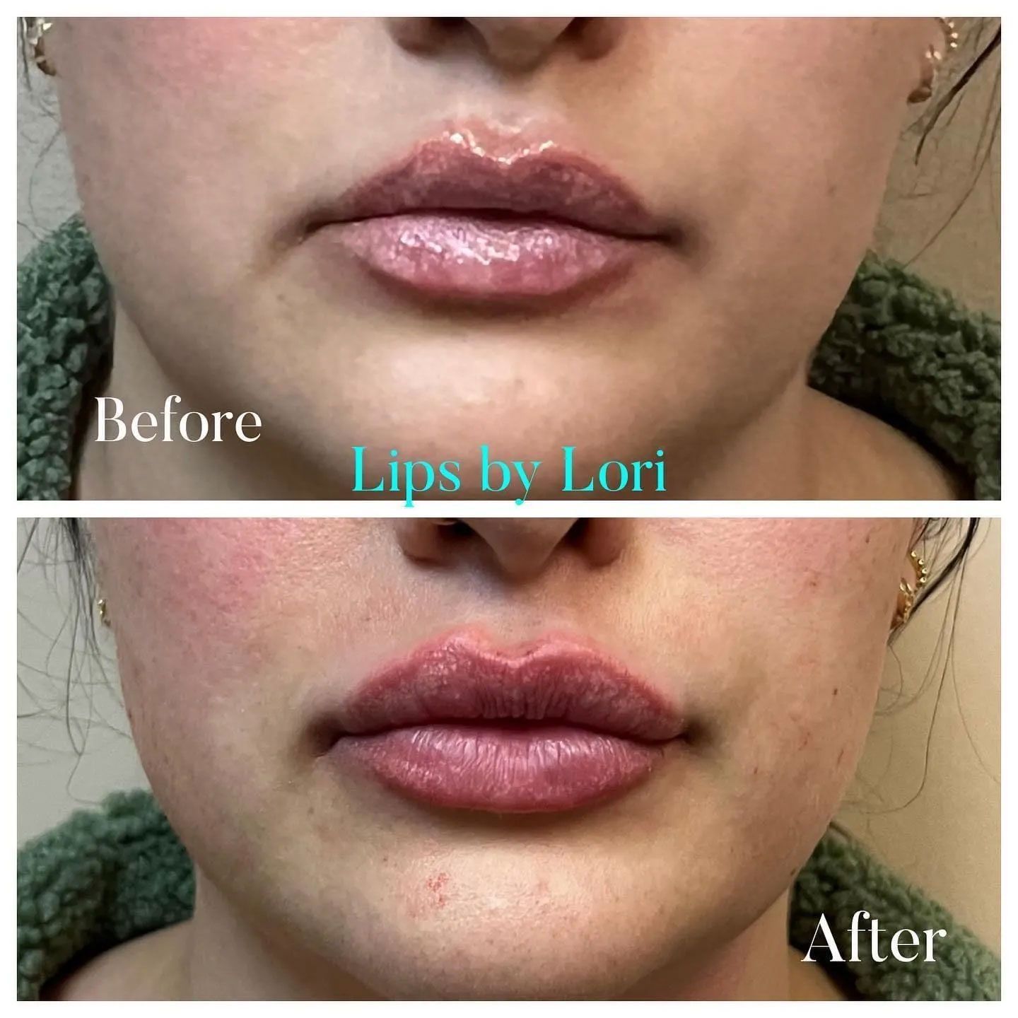 A before and after photo of a woman 's lips by lori