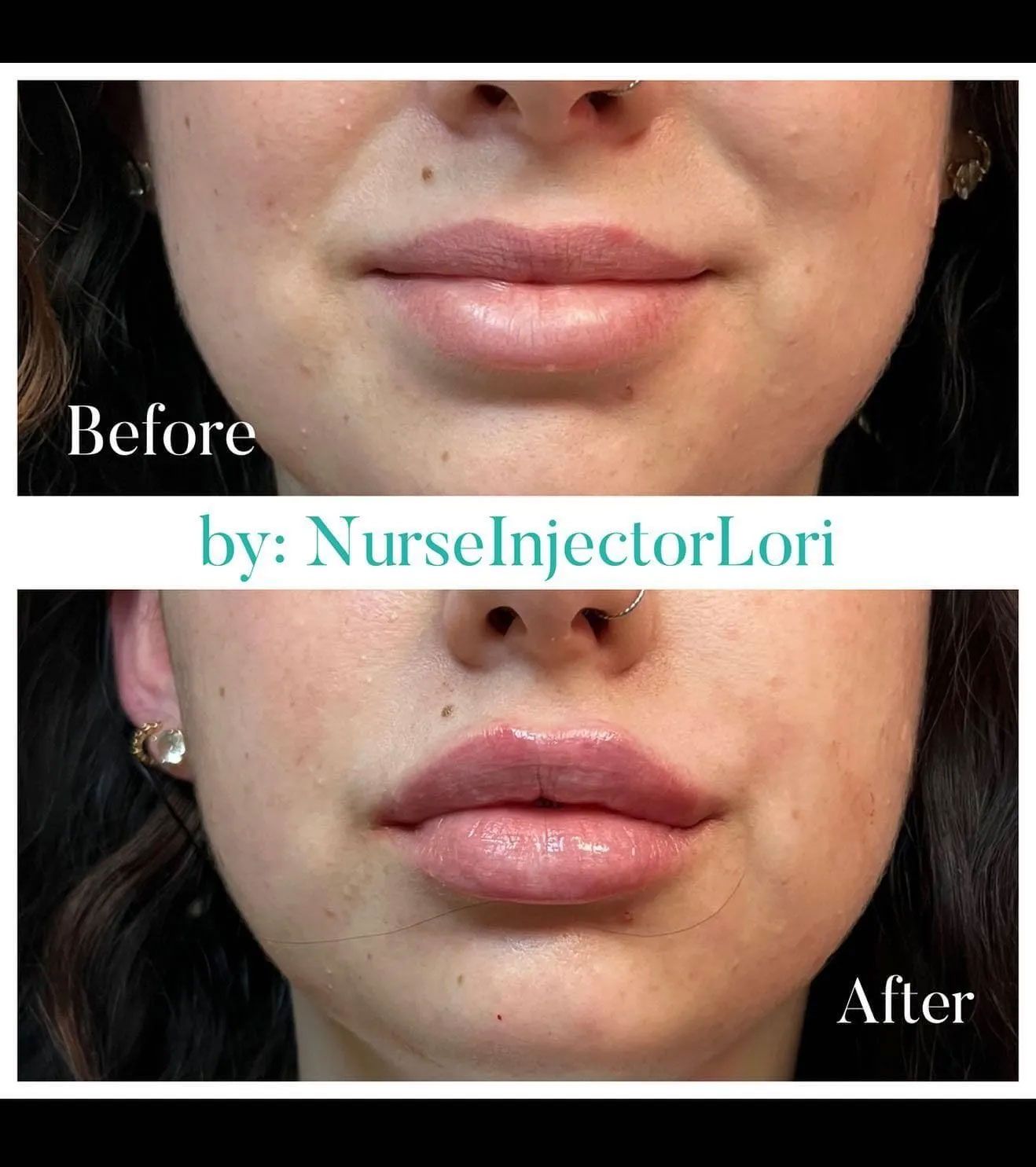 A before and after photo of a woman 's lips.