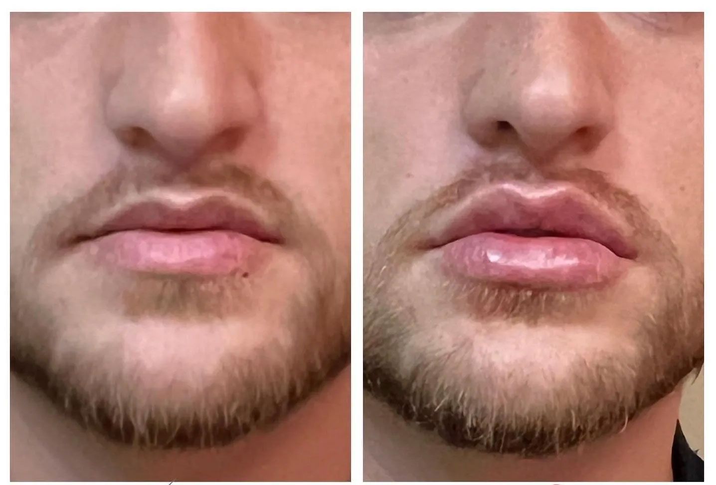 A man with a beard has a before and after picture of his lips.