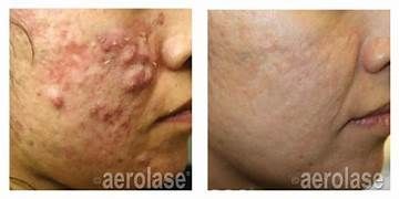 A before and after photo of a woman's face with acne.