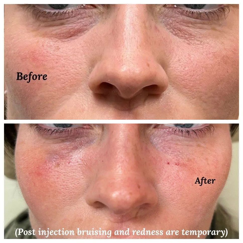 A before and after photo of a woman 's face with tear troughs.