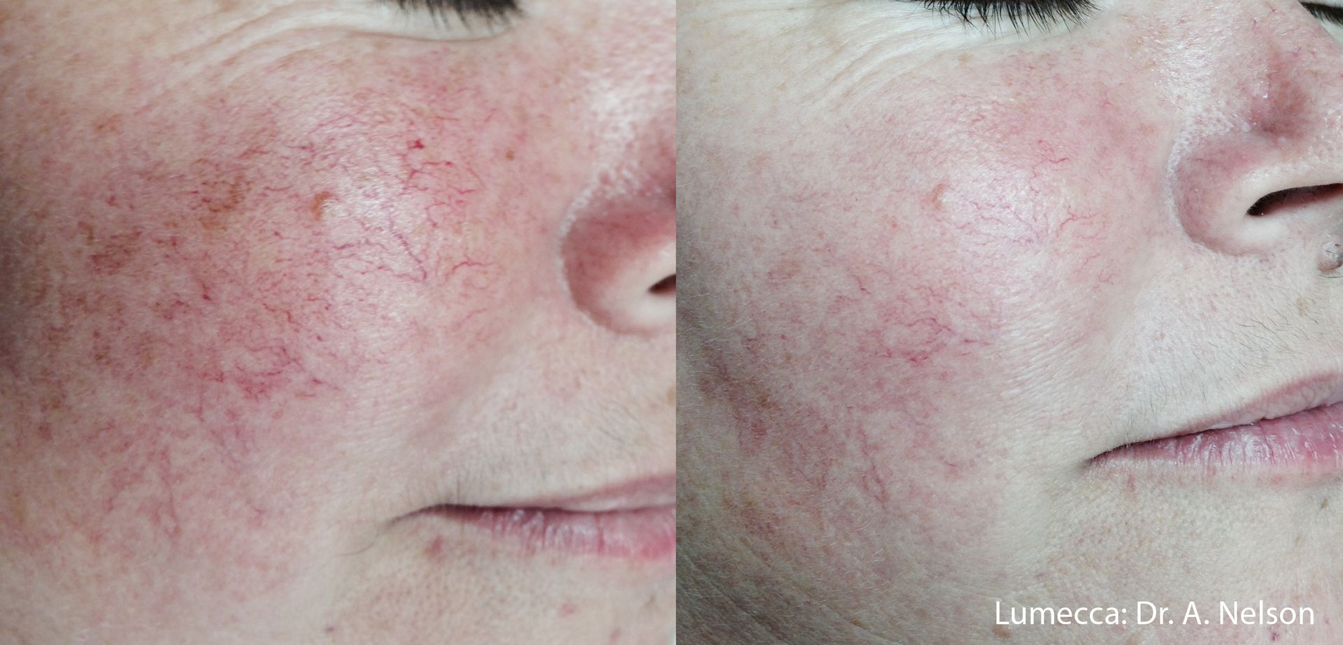 A before and after photo of a woman 's face with red veins.