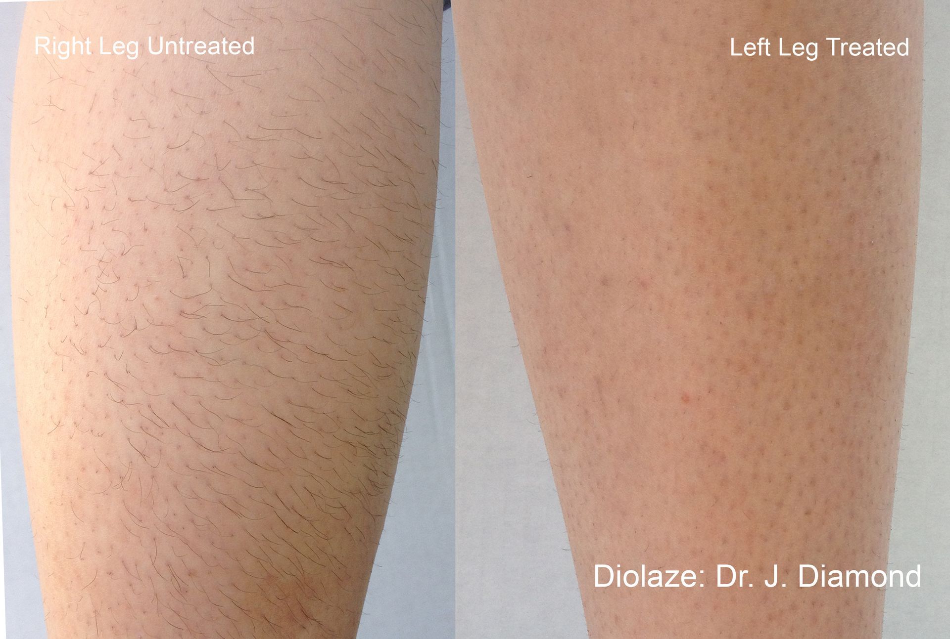 A before and after photo of a woman 's leg