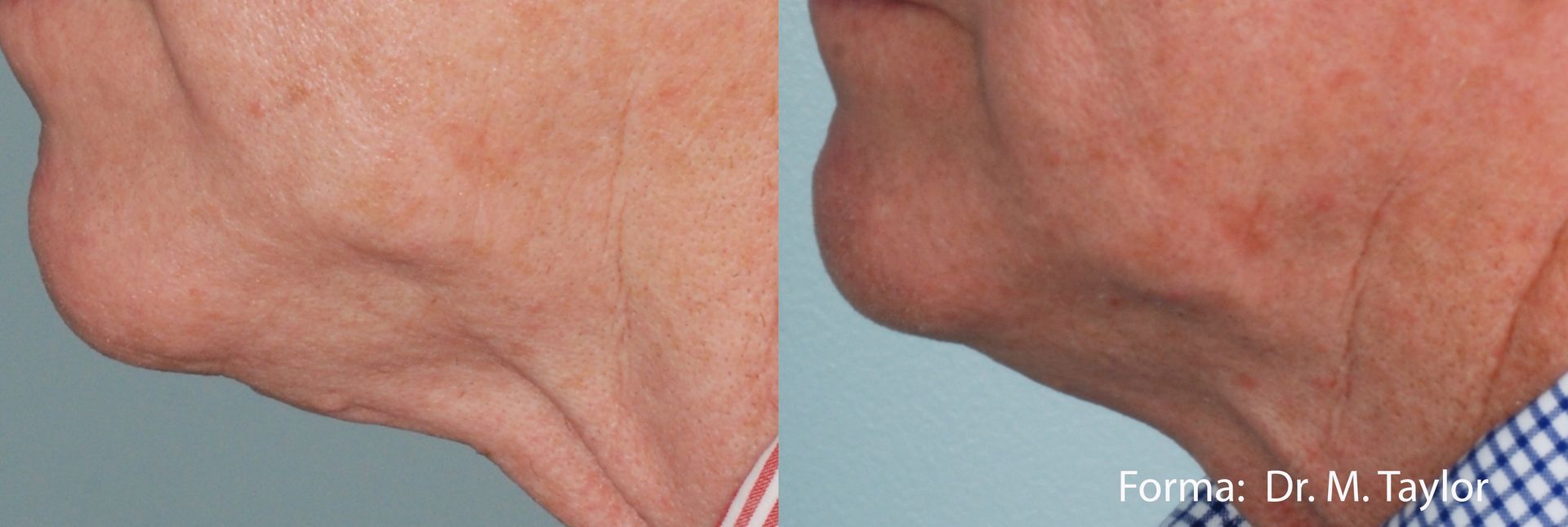 A before and after photo of a man 's neck and face.