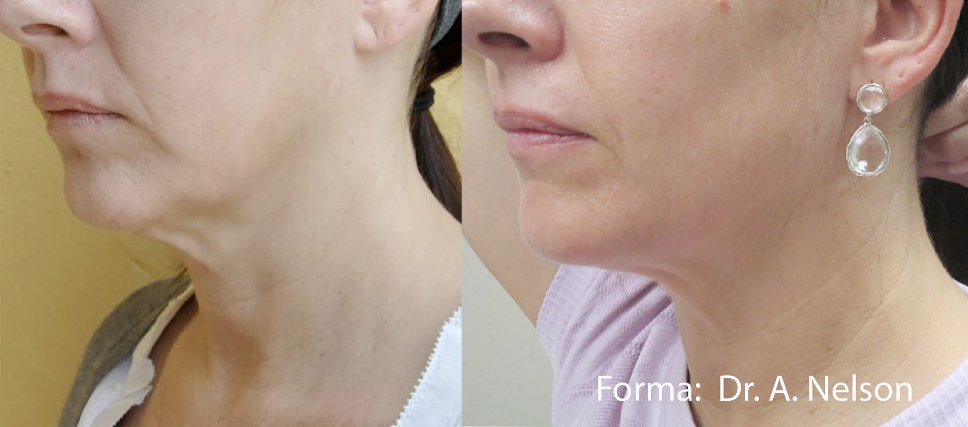 A before and after photo of a woman 's neck and face.