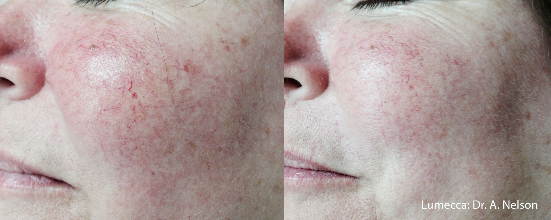 A before and after photo of a woman 's face with red spots.