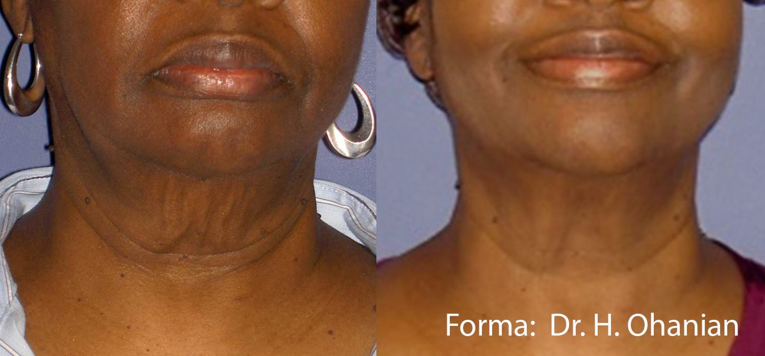 A before and after photo of a woman 's neck and face