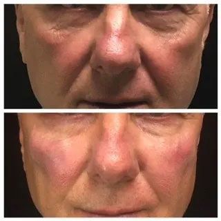A before and after photo of a man 's face with red cheeks.