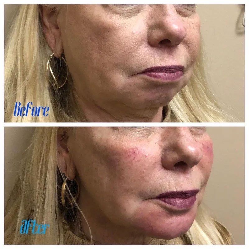 A before and after photo of a woman 's face.