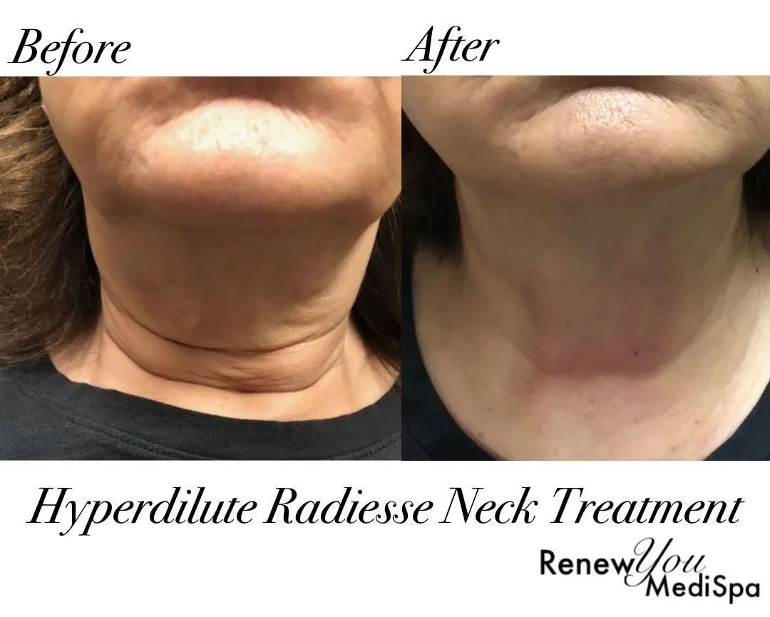 A woman 's neck before and after a hyperdilute radiesse neck treatment.