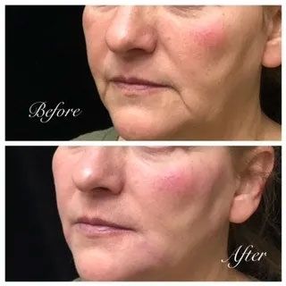 A before and after photo of a woman 's face.