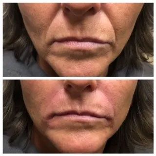 A before and after photo of a woman 's lips.