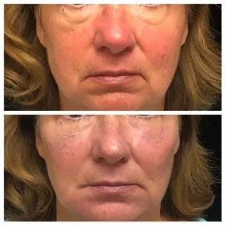 A before and after photo of a woman 's face.