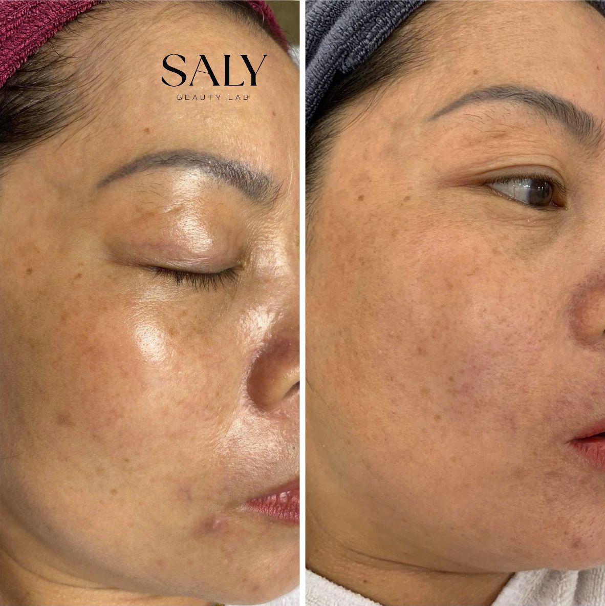 A before and after photo of a woman's face with a towel on her head.