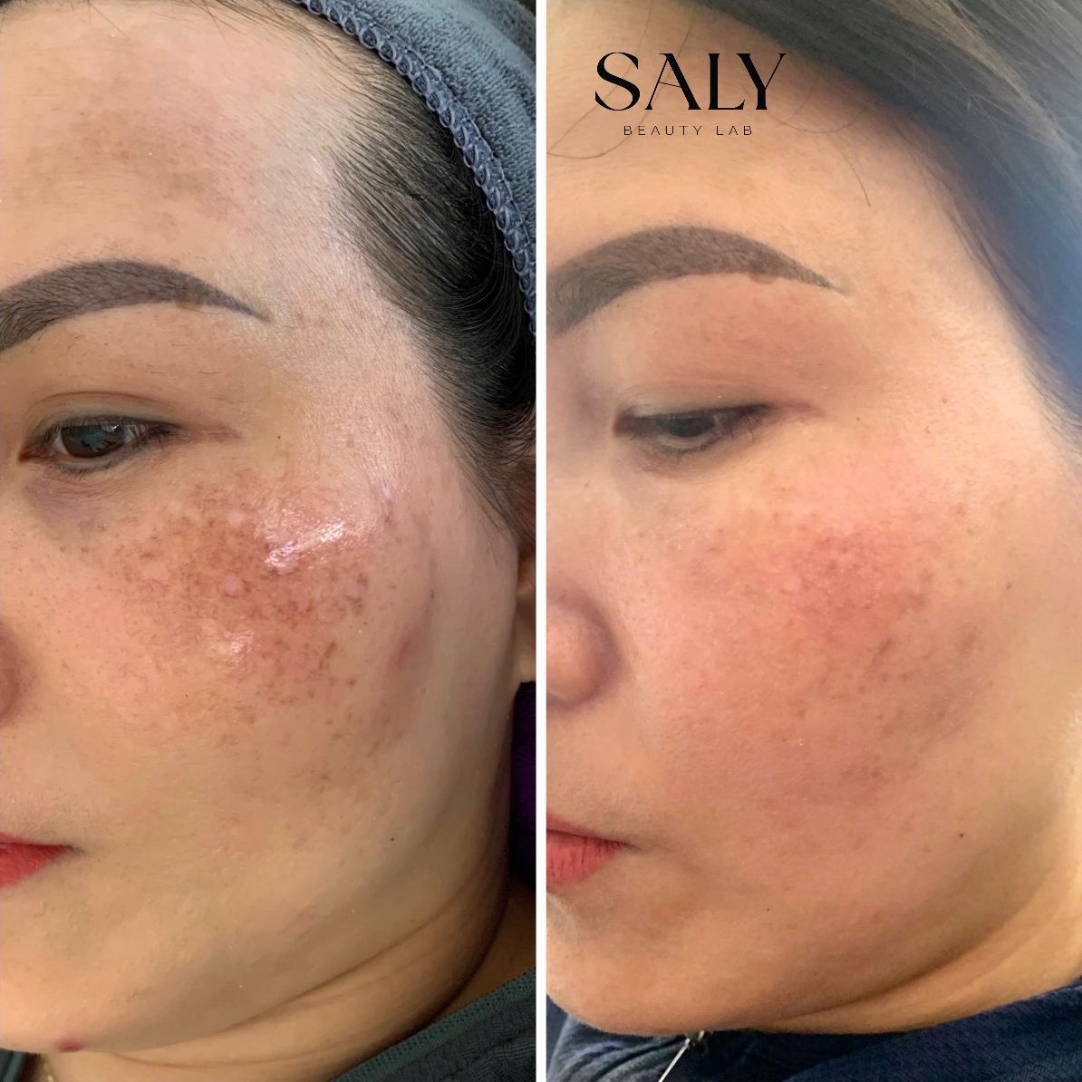 A woman's face is shown before and after a treatment.