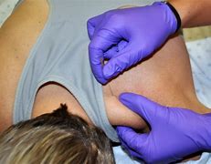 dry needling